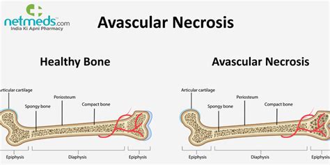 Avascular Necrosis Osteonecrosis Symptoms Causes And Treatment