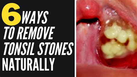 Removing Tonsil Stones At Home Youtube