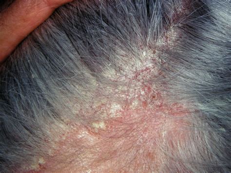 Seborrheic Dermatitis Scalp African American Hair