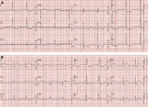 Twelve Lead Electrocardiogram Of A 58 Year Old Female Patient During
