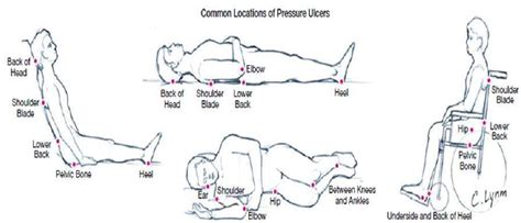 Pressure Ulcer Positioning