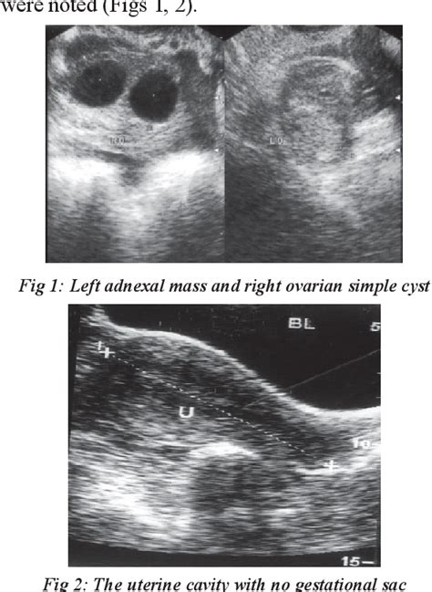 Figure 1 From Molar Pregnancy Presents As Tubal Ectopic Pregnancy
