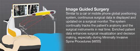 What Is Image Guided Surgery For Spine