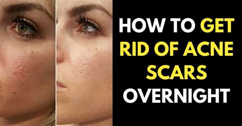 How To Get Rid Of Acne Scars 7 Effective Home Remedies