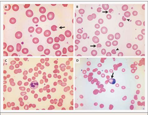 Pdf Diagnosis From The Blood Smear Semantic Scholar