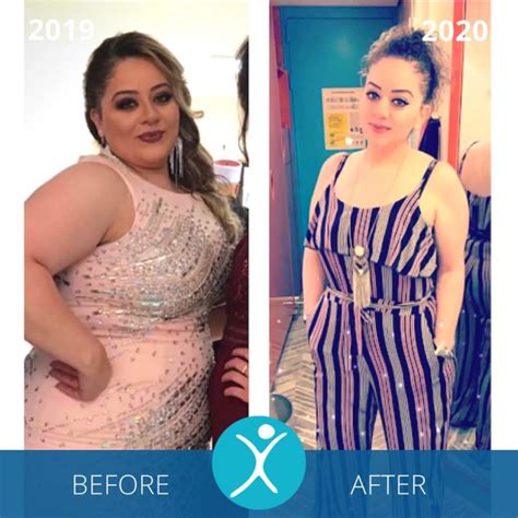 Gastric Sleeve Before And After Photos The Best Pictures Of