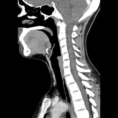 Normal Ct Of The Neck Image