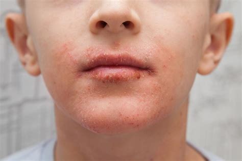 Red Bumpy Rash On Face Around Mouth