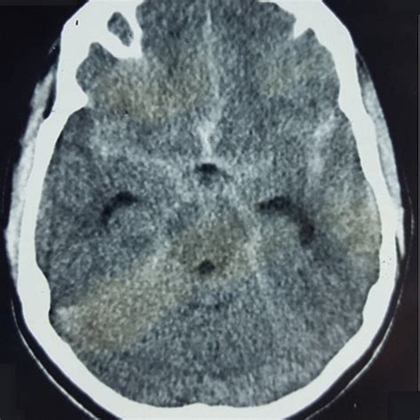 Axial Ct Scan After Second Bleed Demonstrating Left Frontal Haematoma