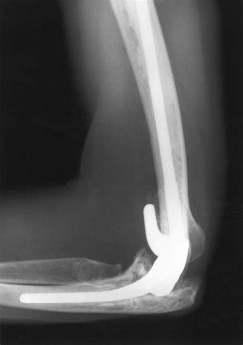 Total Elbow Arthroplasty After Previous Resection Of The Radial Head