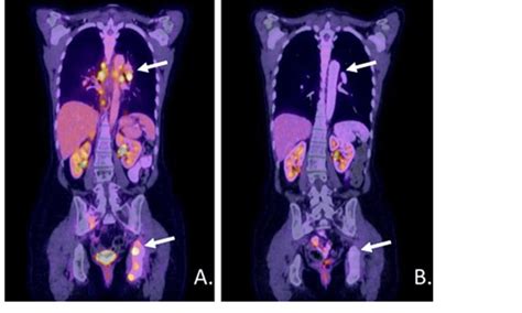 Petct Scans Prior To Initiation Of Abcp Therapy A And After One