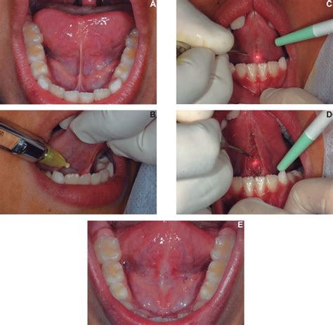 Laser Frenectomy A Short Lingual Frenulum B Infiltrative Anesthesia Download Scientific