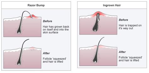 The Best And Only Ways To Avoid Razor Bumps Sheknows