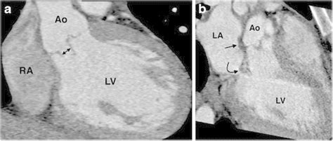 An Ecg Gated Cardiac Ct Angiogram In A Year Old Female Intravenous