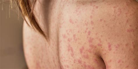 How To Tell Psoriasis Apart From Other Skin Conditions Self