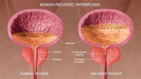 Benign Prostatic Hyperplasia Symptoms Causes And Treatment