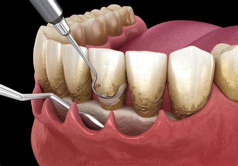 ¿en Qué Consiste Un Curetaje Odas Clínica Dental