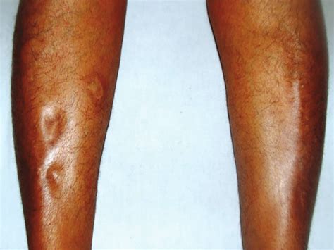 Lower Limb Edema Examination Displaying Pitting Edema Of The Lower Leg