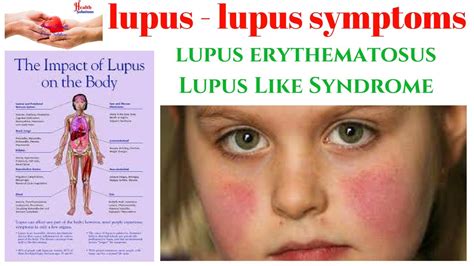 Lupus Lupus Symptoms Lupus Erythematosus Lupus Like Syndrome