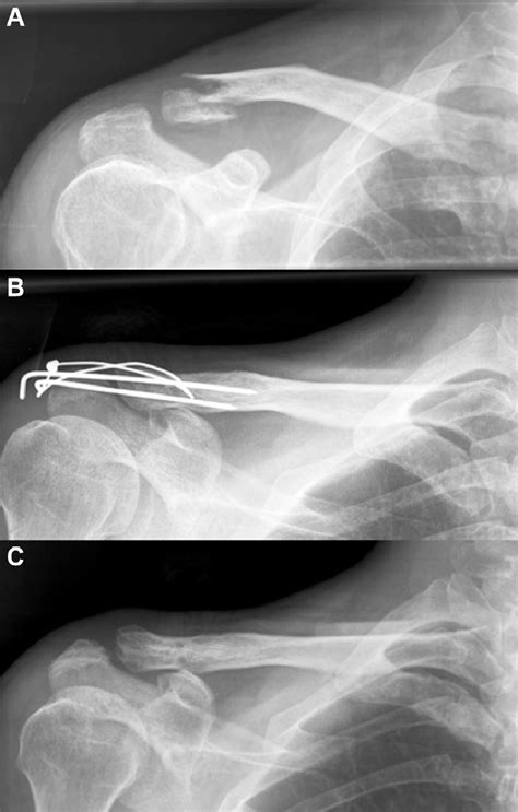 A 34 Year Old Woman With Right Distal Clavicle Fracture Treated With