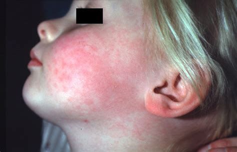 Fifth Disease Images Food Ideas