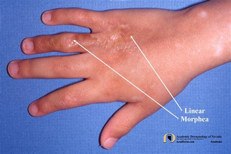 Linear Morphea Linear Scleroderma Academic Dermatology Of Nevada