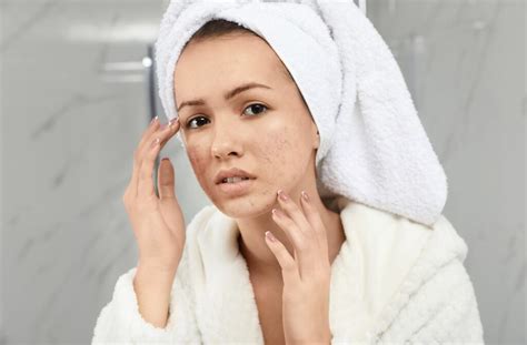 What Is The Best Skincare Routine For Acne Prone Skins