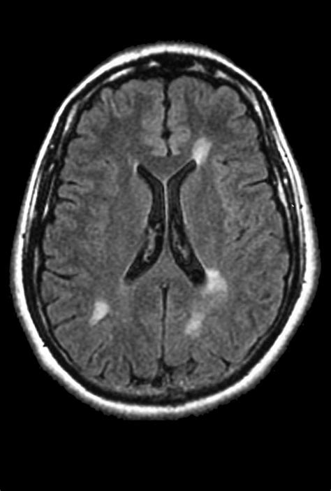 Mri And Ms Diagnosis Does Ms Show Up On Mri Multiple Sclerosis News Today