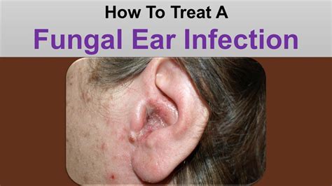 How To Treat A Fungal Ear Infection Youtube