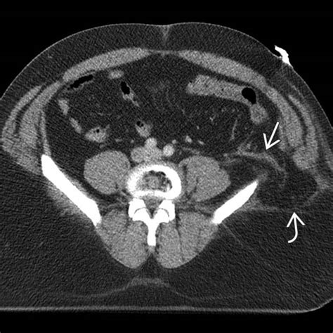 Traumatic Abdominal Wall Hernia Radiology Key
