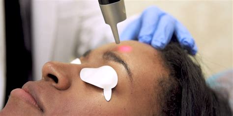 Laser For Dark Skin Picosure Laser Skin Problems Growing Old