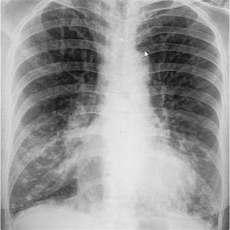 Plain Chest X Ray Showed Bilateral Consolidation In The Basal Lung