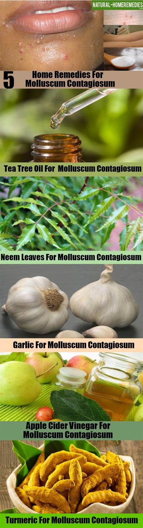 Top 5 Home Remedies For Molluscum Contagiosum Natural Home Remedies