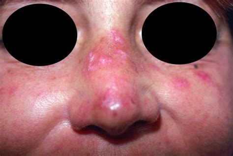 Image Discoid Lupus Erythematosus Of The Face 2 Msd Manual