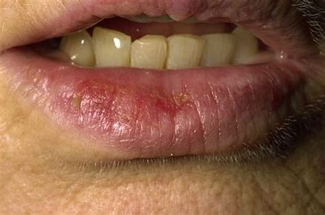 Sunburned Lips Symptoms Blistered And Swollen Relief Skincarederm