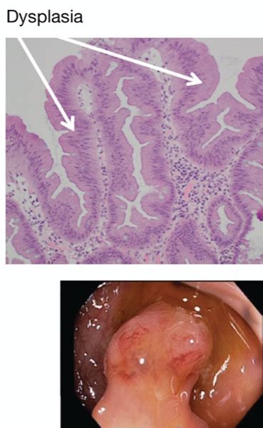 Sessile Serrated Polyps Finding Management