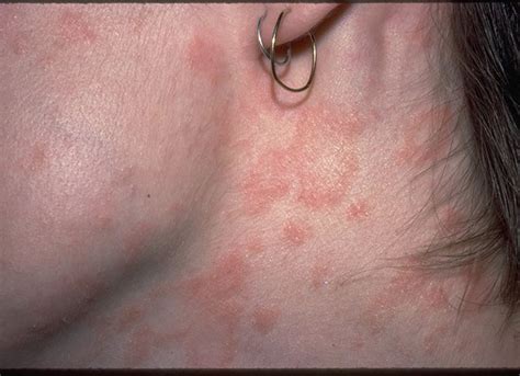 Eczema In Picturesmild To Severe Eczema Eczema Living