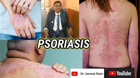 Psoriasis Introductionsignssymptoms Causesdiagnosis And Treatment
