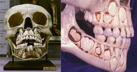 Baby Teeth Skeleton Xray Lashawna Wilkes