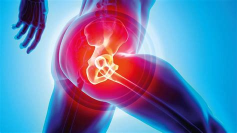 Hip Replacement The Pros And Cons Of Early Surgery The Chartered