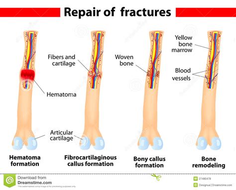 Bone Fracture Healing Process Royalty Free Stock Photos Image 27480478