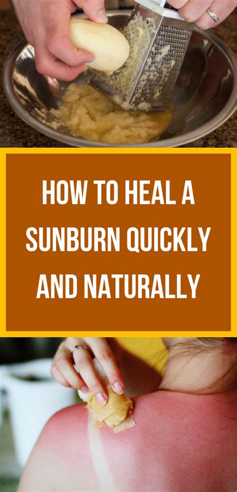 How To Heal A Sunburn Quickly And Naturally