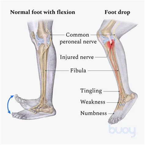 Common Peroneal Nerve Injury Flashcards Quizlet