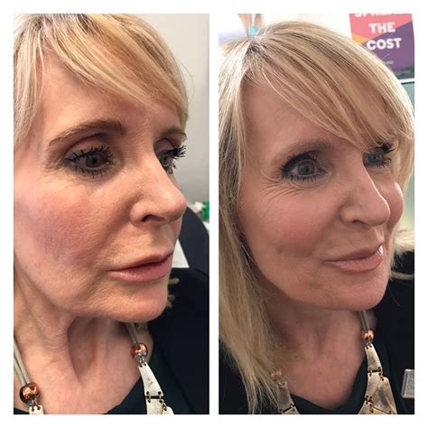 Chin Filler Before And After Batmanparking