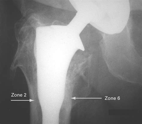 Revision Of Cemented Hip Arthroplasty Using A Hydroxyapatite Ceramic