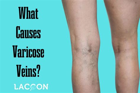Risk Factors Involved What Causes Varicose Veins Lacoon