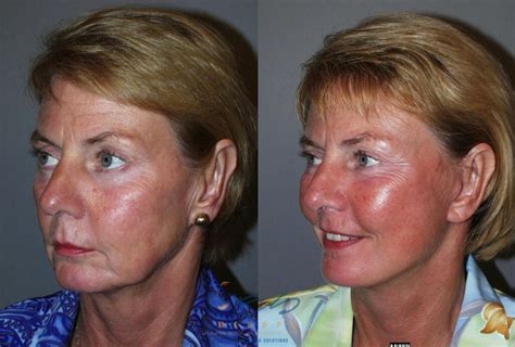 Face Lift And Neck Lift Before And After Photos Patient 47 Vancouver Bc