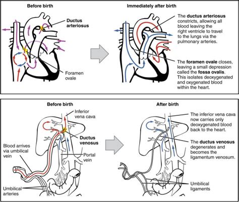 Fetal Circulation Transition At Birth And Persistent Fetal