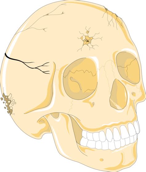 Depressed Skull Fracture Symptoms And Treatment Sanjay Hospital