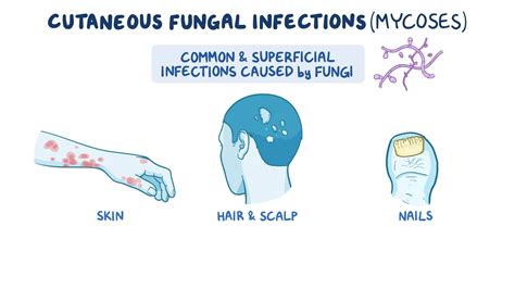 Cutaneous Fungal Infections Nursing Osmosis Video Library